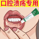 TRINOLONE ORAL PASTENIDA泰國口腔潰瘍凝膠膏嘴巴上火起泡口舌生瘡緩解疼痛貼修復黏膜 濃效精華999+【高效款】一抹即愈