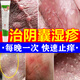 999皮炎平糠酸莫米松凝膠 陰囊潮濕瘙癢男人專(zhuān)用止癢去癢根陰囊濕疹專(zhuān)用藥男性下面蛋蛋睪丸癢股癬專(zhuān)用 1支裝【陰囊瘙癢潮濕】