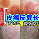 體股癬牛皮膚癬專(zhuān)用特正效藥銀屑病藥膏真菌王止癢抑菌皮膚皮炎濕疹皮癬真菌感染止癢膏身體癢硝酸咪康唑乳膏 1盒硝酸【皮炎濕疹皮癬真菌感染】醫用級