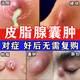 皮脂腺囊腫專用藥膏去除皮下痘痘粉瘤增生脂肪硬塊膿包結(jié)節(jié)暗瘡火癤子專用軟膏皮膚用藥 莫匹羅星軟膏 1盒【皮脂腺囊腫專用藥膏】