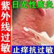 紫外線過敏專用藥膏光敏性日光性皮炎特專用效藥曬傷修復(fù)藥膏屏障受損泛紅倍皮膚過敏癢復(fù)方倍氯米松樟腦乳膏 1盒【瘙癢脫皮腫脹】醫(yī)用級