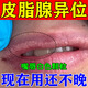 皮脂腺異位癥去除嘴唇上長白點(diǎn)干裂起泡皰疹唇炎唇膏口角炎爛嘴角 一盒【發(fā)一盒】