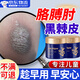 胳膊肘黑色素沉淀快速去除手肘關(guān)節胳膊肘去黑神器黑色素沉淀藥膏 淡化黑色素清潔按摩膏80g/罐