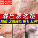 淋巴痘腮邊痘下巴長(cháng)痘痘祛痘藥膏硬塊痘反復長(cháng)痘結節玫瑰痤瘡專(zhuān)用排毒脖子額頭臉頰兩邊痤瘡紅腫消炎軟化痘痘 淋巴痘腮邊痘消炎軟化祛痘膏