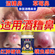 克頓默奧酒糟鼻草莓鼻紅腫玫瑰痤瘡紅鼻子專用去粉刺黑頭紅血絲螨蟲修護(hù)軟 一盒初期裝（輕微型） 搭紅鼻子酒糟鼻頭紅腫消炎產(chǎn)品用