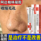 阿達帕林凝膠改得善毛孔粗大醫用祛的痘消炎痤瘡硬疙瘩專(zhuān)用藥痘痘粉刺痘印治療粉刺膿包皮膚用藥（視覺(jué)特效） 3盒裝【毛孔粗大可用】皮膚用藥 非處方藥