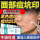 藤石制藥【醫(yī)用】痘坑修復(fù)凹洞生長(zhǎng)因子臉部用痘印痘疤修復(fù)凹洞填充再生BC 買(mǎi)三送二【鞏固裝】痘坑生長(zhǎng)因子修復(fù)膏+棉簽*1
