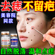 FLYMAN點(diǎn)痣膏醫(yī)用專用官方正品去痣點(diǎn)痣膏點(diǎn)疣（藥監(jiān)備案）水去黑痣祛斑 1盒【點(diǎn)痣膏+修復(fù)液】臉部不留疤痕