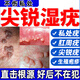 九春制藥尖銳濕疣藥私處專(zhuān)用脫落膏hpv去i疣體抗hpv病毒轉陰男女菜花狀疣 買(mǎi)3送2【好后不在犯】特效療程