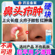 鼻子紅腫有膿包鼻子毛囊炎疥腫可搭配藥膏長(cháng)痘專(zhuān)用酒糟鼻輔助消炎火癤子可去紅鼻頭腫包毛孔粗大痤瘡粉刺N3 1盒裝 送棉簽【輕微鼻頭痘痘適用】