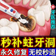 專攻蛀牙洞牙膏清理牙蟲防齲齒日本進口再生硅自己填充劑補牙神器 1支/120g【體驗裝】輕度蛀牙修