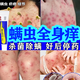 去螨蟲(chóng)皮膚用藥除螨蟲(chóng)的特止癢的效藥止癢抑菌皮膚瘙癢皮炎濕疹真菌身體癢臉部后背部癢長(cháng)疙瘩祛痘丹皮酚軟膏 1盒裝【去除螨蟲(chóng)疥螨跳蚤專(zhuān)用藥】一抹殺菌除螨
