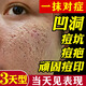 北京同仁堂痘印痘坑修復凹洞填充再生非藥乳膏祛痘印淡化消除男生去痘印痘疤 單盒【官方正品】