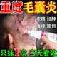 毛囊炎頭部專用藥頭皮癢止癢頭皮起膿包疙瘩藥膏真菌感染脂溢性皮炎皮膚用藥克林霉素甲硝唑搽劑【視覺特效】 一盒【毛囊炎專用】