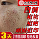 同仁堂祛痘印痘坑修復淡化痘坑修復凹洞黑色素沉淀淡化去痘痘和痘印粉刺 一盒裝【祛痘淡印】