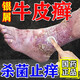 華佗膏治牛皮癬銀屑病專(zhuān)用藥頑固牛皮癬銀屑病去真菌止癢抑菌皮膚藥膏皮膚瘙癢身體癢華佗膏皮膚用藥【視覺(jué)特效】 3盒華佗膏【嚴重牛皮癬 全身白屑】