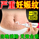 樂(lè )修妊娠紋修復霜產(chǎn)后去除消除緊致肚皮孕婦橄欖油專(zhuān)用淡化生長(cháng)紋藥膏 一盒裝【淡化妊娠紋】 妊娠紋消除去妊娠紋