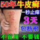 巖井昃弘銀屑病牛皮癬100%頑固皮癬專(zhuān)用真菌止癢頑固抑菌根皮膚治瘙癢藥膏 特效一盒【一抹見(jiàn)?？臁空婢?進(jìn)口牛皮癬真菌王膏止癢抑菌皮膚