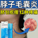 優(yōu)立特脖子毛囊炎噴霧劑馬拉色菌真菌感染治療頭部手臂上長(zhǎng)痘痘疙瘩NH 買二送一【3盒周期裝】膿包痘痘 紅腫疼痛