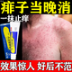 治痱子專用藥膏熱痱子濕疹專用藥祛痱止癢嬰兒痱子熱痱疹子?jì)胗變簩Ｓ灭蜃觟水祛痱止癢祛熱抑菌丹皮酚軟膏 5盒【198種痱子一次性解決】直擊病灶 不再范