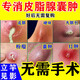 皮脂腺囊腫專用藥膏拔毒火癤子膿包疙瘩皮脂腺囊腫火癤子專用軟藥膏脂肪瘤毛囊炎專用特正效藥莫匹羅星軟膏 1盒【皮脂腺囊腫專用藥膏】