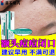 藤石制藥兒童額頭上紅腫小顆粒痘痘膏閉口毛囊炎臉上紅疙瘩逆光疹凝膠CN 單盒【藥監備案】額頭痘痘毛囊炎 送棉簽