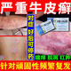牛皮癬藥銀屑病專(zhuān)用藥膏頑固牛皮癬銀屑病口服藥皮膚瘙癢紅斑成片白色鱗屑嚴重牛皮癬特專(zhuān)效用藥療癬卡西甫散 3盒療程裝【皮膚瘙癢鱗屑 紅斑成片】