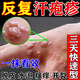 汗皰疹藥膏手上癢起泡專(zhuān)用真菌感染濕疹止癢手起水泡癢脫皮干裂去i根皮膚用藥非處方藥復(fù)方倍氯米松樟腦乳膏 1盒【手上起水泡手指真菌感染】汗皰疹專(zhuān)用