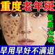 萊覽奧蓋祛斑霜美白淡化老年黃褐雀斑黑色素專用去除男女士一夜消醫(yī)用正品 純中藥美白祛斑霜 臉部手背祛斑效果最好的產(chǎn)品