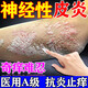 神經(jīng)性皮炎專(zhuān)用頑固藥皮膚瘙癢止癢藥皮炎濕疹真菌復方倍氯米松樟腦乳膏皮膚用藥（100%發(fā)貨 視覺(jué)特效） 一盒裝【一抹止癢】抗炎殺菌