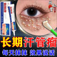 香港大藥房脂肪粒去除藥膏神器眼部專(zhuān)用眼霜消除汗管瘤脂肪油脂粒粟丘疹克星 一盒：【眼角周?chē)玖！? title=