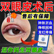 內廷上用雙眼皮術(shù)后熱敷眼罩醫用割雙眼皮蒸汽眼罩消腫醫用術(shù)眼部熱敷貼眼單盒（體驗裝）