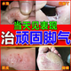 達克寧腳氣藥止癢脫皮爛腳丫真菌感染治腳氣皮膚用藥 非處方藥爛腳丫的特藥腳爛腳趾縫潰爛癢硝酸咪康唑乳膏 2盒【硝酸咪康唑乳膏】癢的受不了 老是摳腳 達克寧腳氣藥止癢脫皮爛腳丫真菌感染治腳氣