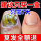 香港大藥房灰指甲特傚效藥第1名正品指甲真菌感染脫甲壞甲根好治鳳仙花護理 【一個灰甲一盒就行】一盒裝