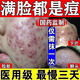 膠態(tài)硫軟膏專祛痘業(yè)殺菌藥膏祛痘消炎痤瘡專用青少年去痘痘和痘印青春痘祛痘膏學(xué)生痘痘修復(fù)消炎痘印閉口粉刺 1盒 【國(guó)藥準(zhǔn)字 建議多盒】