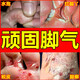 達(dá)克寧腳氣藥止癢脫皮爛腳丫真菌感染治腳氣達(dá)克寧硝酸咪康唑乳膏腳臭腳氣藥止癢真菌感染皮膚用藥 非處方藥 1盒【腳脫皮 癢的受不了】用了都說好 達(dá)克寧腳氣藥止癢脫皮爛腳丫真菌感染治腳氣