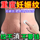北京同仁堂妊娠紋修復(fù)霜產(chǎn)后去緊致除肚皮孕婦修復(fù)霜淡化生長妊娠紋祛疤膏藥 買2送1【周期裝】專消妊娠紋 妊娠紋祛疤痕專用修復(fù)
