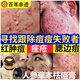 澳芙雪人參草本祛痘膏淡化青春痘霜凝膠正品粉刺痘坑痘印痤瘡專用 一瓶裝