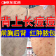 克林霉素甲硝唑搽劑前胸后背長痘紅腫瘙癢手臂毛囊炎長痘痘胳膊上的小疙瘩有黑點堵塞藥消炎去根皮膚用藥 一盒【胸前身上長疙瘩膿包毛囊炎專用藥】