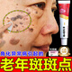 維a酸乳膏0.1角化異常引起老年斑臉部手背祛斑點斑專用OTC藥霜水去老人斑老年斑專用OTC藥一皮夜消 1盒
