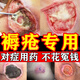 褥瘡特專(zhuān)效藥褥瘡膏老人臀部外用褥瘡潰爛長(cháng)期臥床皮膚潰爛藥促進(jìn)傷口愈合壓瘡水皰紅斑疼痛肌肉外露硼酸軟膏 3盒【嚴重褥瘡 皮膚壞死 腐肉空瘺】療程裝