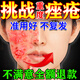 喬記本草醫用祛痘消炎面膜痤瘡專(zhuān)用膏藥青少年學(xué)生去青春痘粉刺硬疙瘩痘印 一盒面膜【發(fā)貨特效快】 祛痘消炎痤瘡專(zhuān)用面膜淡化痘印修復皮膚屏障