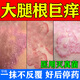 股癬專(zhuān)用藥膏股蘚大腿內側真菌感染腹股溝股癬大腿內側瘙癢紅疹越抓越癢皮膚瘙癢皮炎濕疹去止癢根克霉唑乳膏 1盒【大腿內側潮濕男人專(zhuān)用止癢膏】早用不遭罪