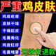 雞皮膚去除神器去雞皮膚毛囊角質(zhì)疙瘩大腿手臂磨砂霜身體乳沐浴露 德國監(jiān)制【買二送一】可試