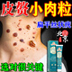 北京同仁堂皮贅去除藥膏肉粒去除神器脖子長(cháng)小肉粒疙瘩腋下絲狀肉球扁平疣膏 單盒【體驗裝】