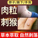 森卓止尤凈跖疣專用非藥腳底趾疣根鴉膽子腳上疣體肉刺祛疣去除非藥膏 【肉粒猴子】1盒裝藍(lán)色去尤樂