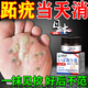 秋雅奈緒日本跖疣腳底拓趾疣凈足部根去專(zhuān)用hpv雞眼無(wú)痛肉刺脫落藥膏貼 一盒裝【快速見(jiàn)效】特效膏