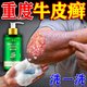 新悠西牛皮癬沐浴露專(zhuān)用皮膚癬非藥頑固銀屑病真菌止癢抑菌皮膚頭部瘙癢 買(mǎi)二送一 【100%發(fā)貨特效】3盒裝