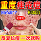 克林霉素甲硝唑搽劑臉上痘痘消炎藥祛痘藥膏醫(yī)用祛痘消炎痤瘡硬疙瘩專用藥青少年粉刺膿皰痤瘡硬疙瘩皮膚用藥 2盒【痘痘粉刺痤瘡專用藥】藥師力薦 臉上反復(fù)冒痘-額頭長痘痘痤瘡粉刺硬疙瘩