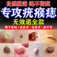 秋雅奈緒去除疣體藥膏疣清寧扁平疣絲狀疣瘊子專用脫落膏祛疣神器點(diǎn)痣藥水 祛疣液 1盒【進(jìn)口祛疣刺猴疙瘩】 去除面部脖子小肉粒尤猴子醫(yī)用軟